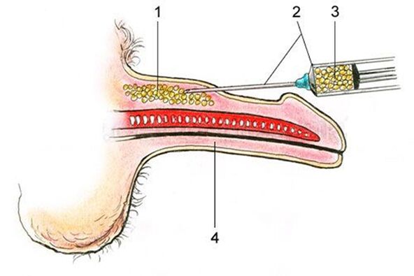 Lipofilling - a introdución de tecido adiposo no eixe do pene