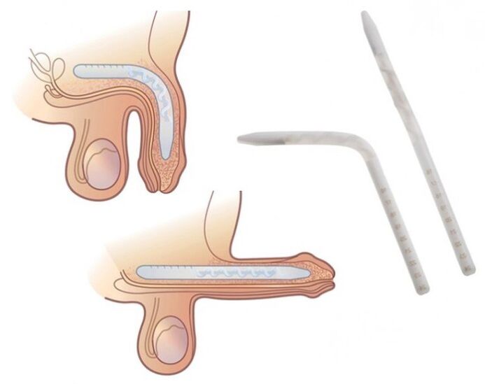 Fallaplastia para aumentar un membro