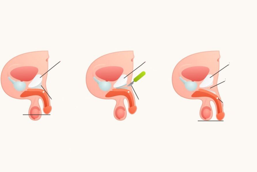 Ligamentotomía para aumentar o pene