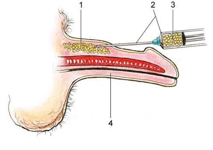 lipofiling para aumentar un membro