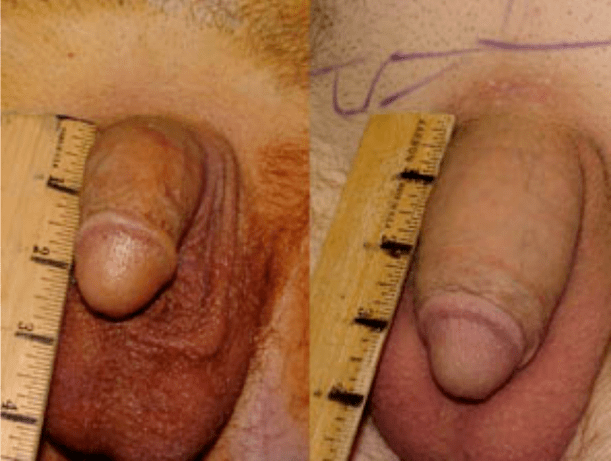 Antes e despois de lipofilling e implantación de gel