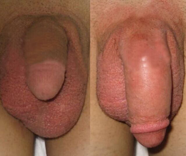 O resultado da instalación dunha matriz de coláxeno no pene