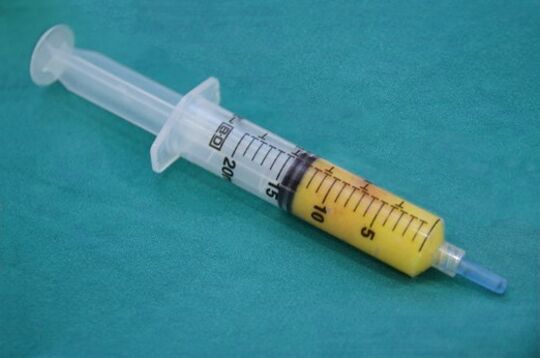 Xiringa con tecido adiposo para lipofilling