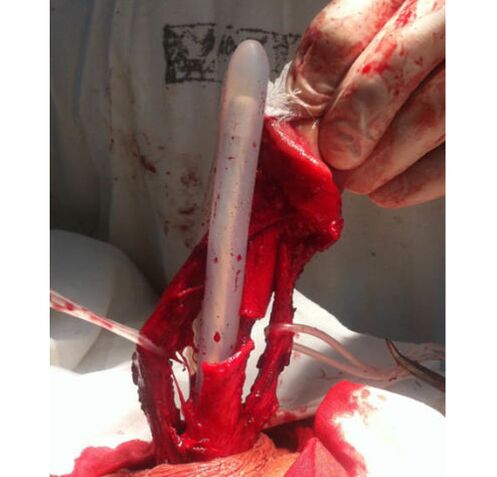 Transplante de tecido muscular para agrandar o pene